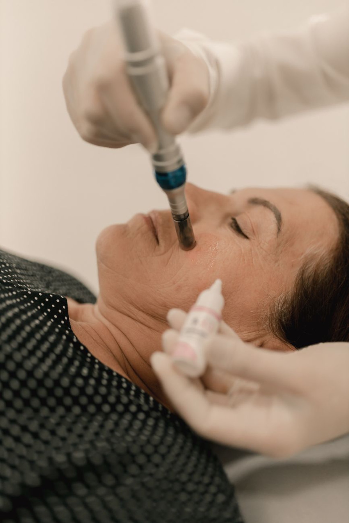 Microdermabrasion