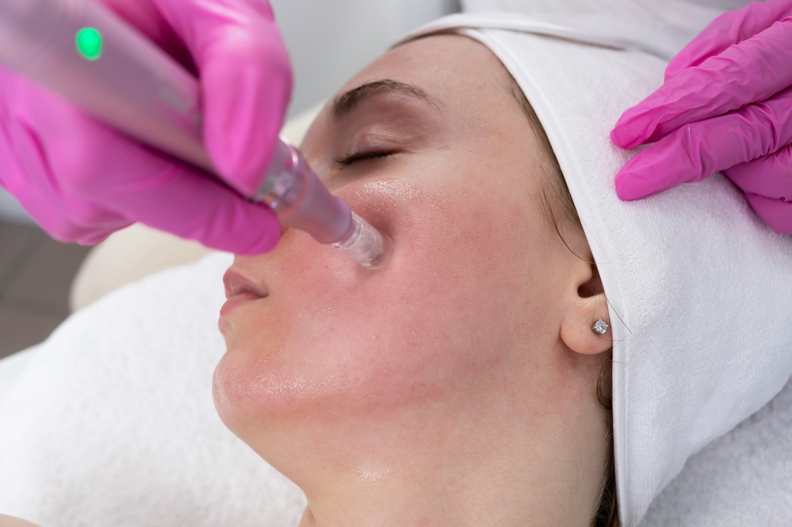 Microneedling